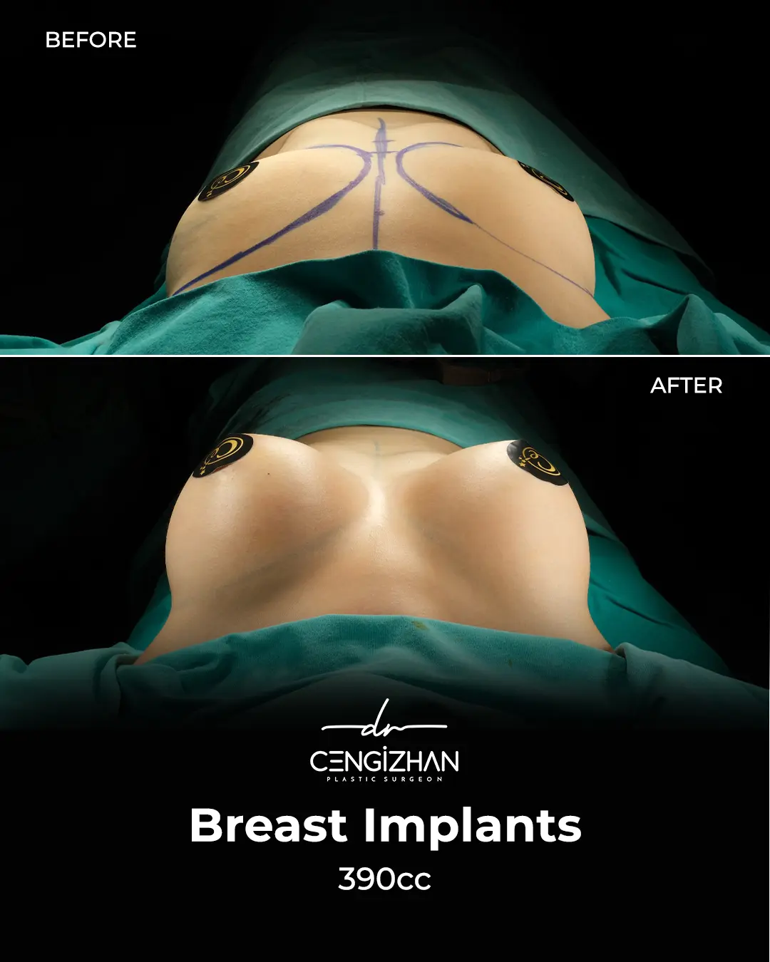 Breast Implant Before and After by Dr. Cengizhan Ekizceli