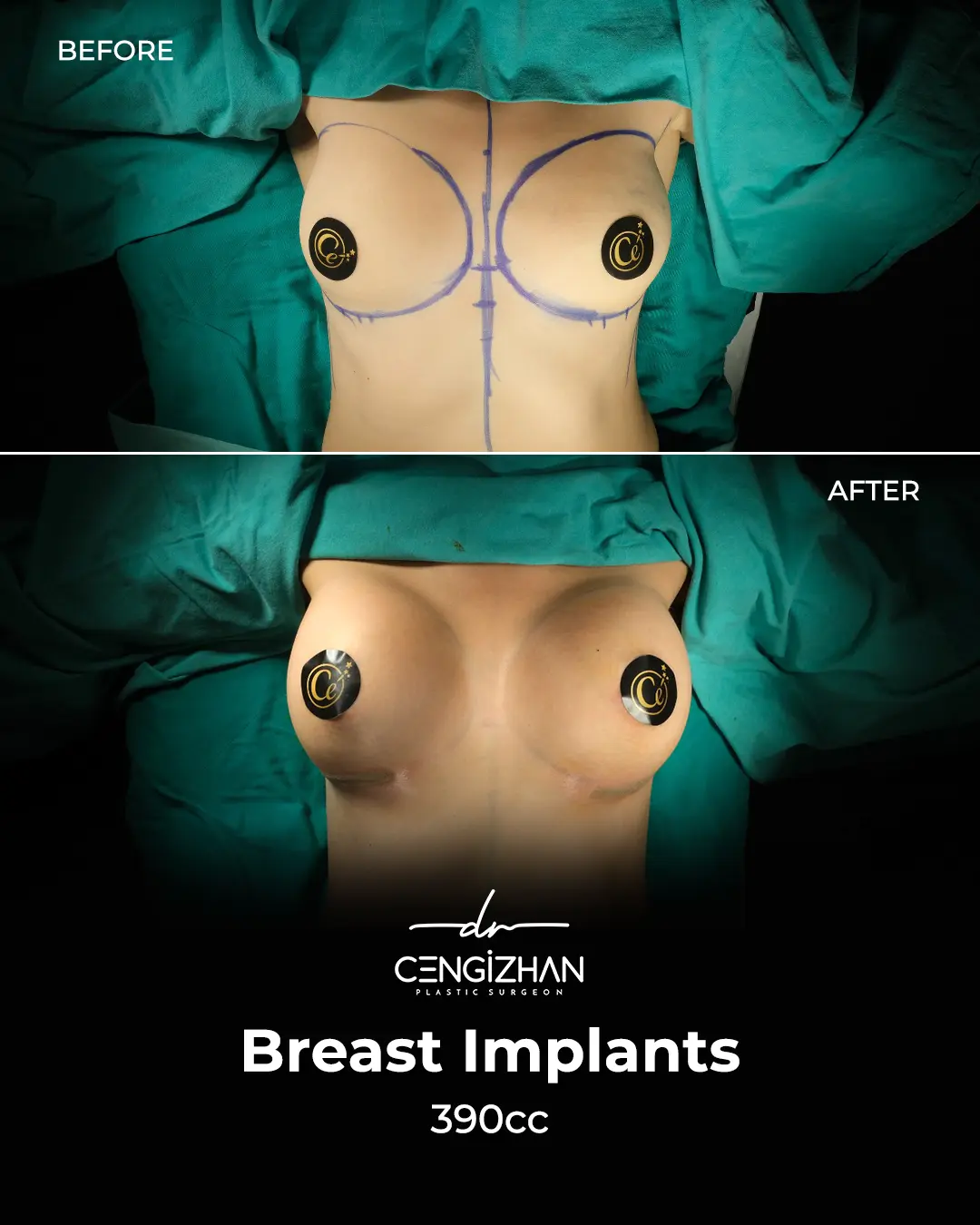 Breast Implant Before and After by Dr. Cengizhan Ekizceli