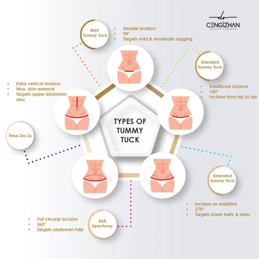 Infografik: 5 Arten der Bauchdeckenstraffung (Tummy Tuck) in der Türkei – Mini, Standard, Extended, Belt Lipectomy und Fleur-de-Lis.
