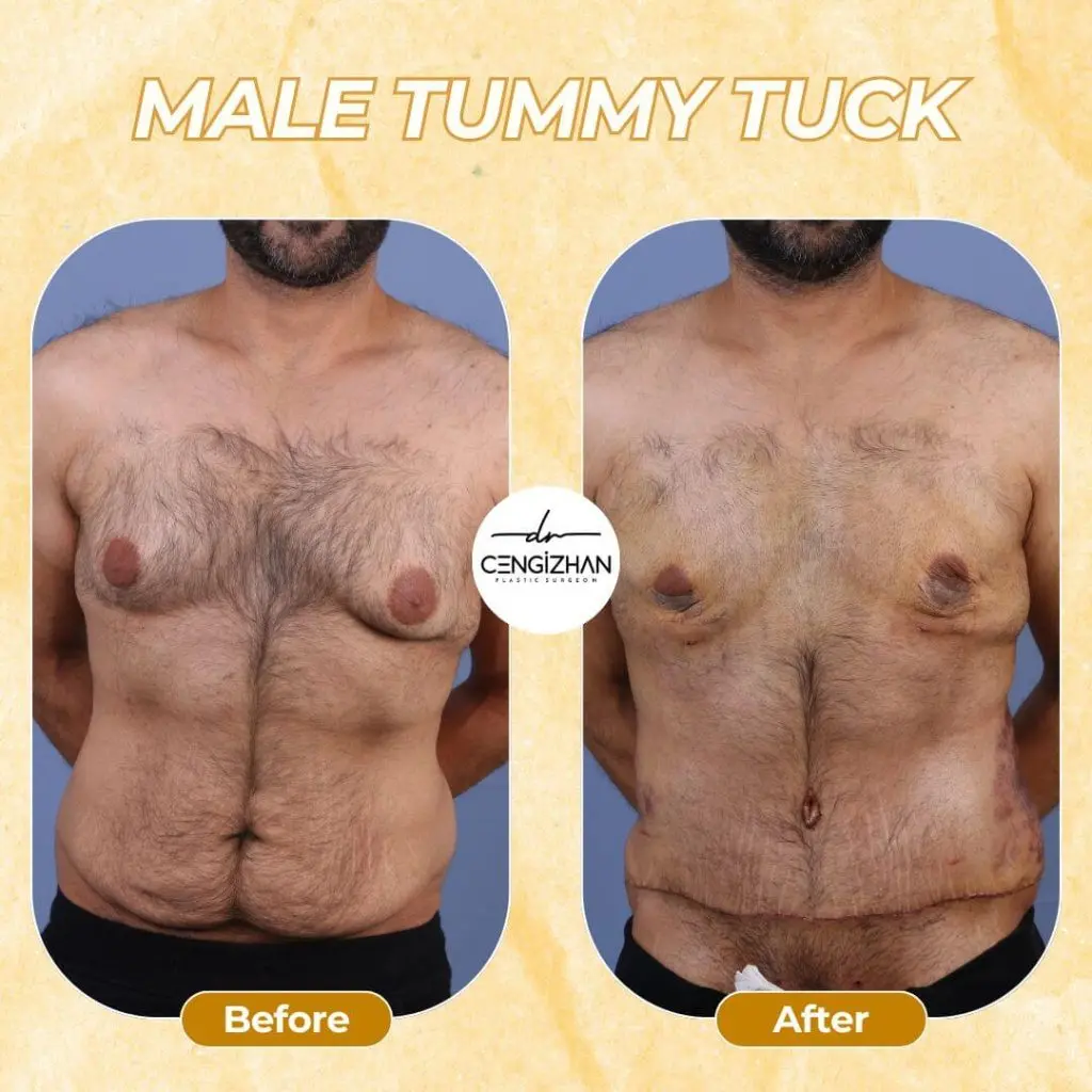 Vorher-Nachher: Bauchdeckenstraffung für Männer (Male Tummy Tuck) in der Türkei – gestraffter, flacher Bauch.