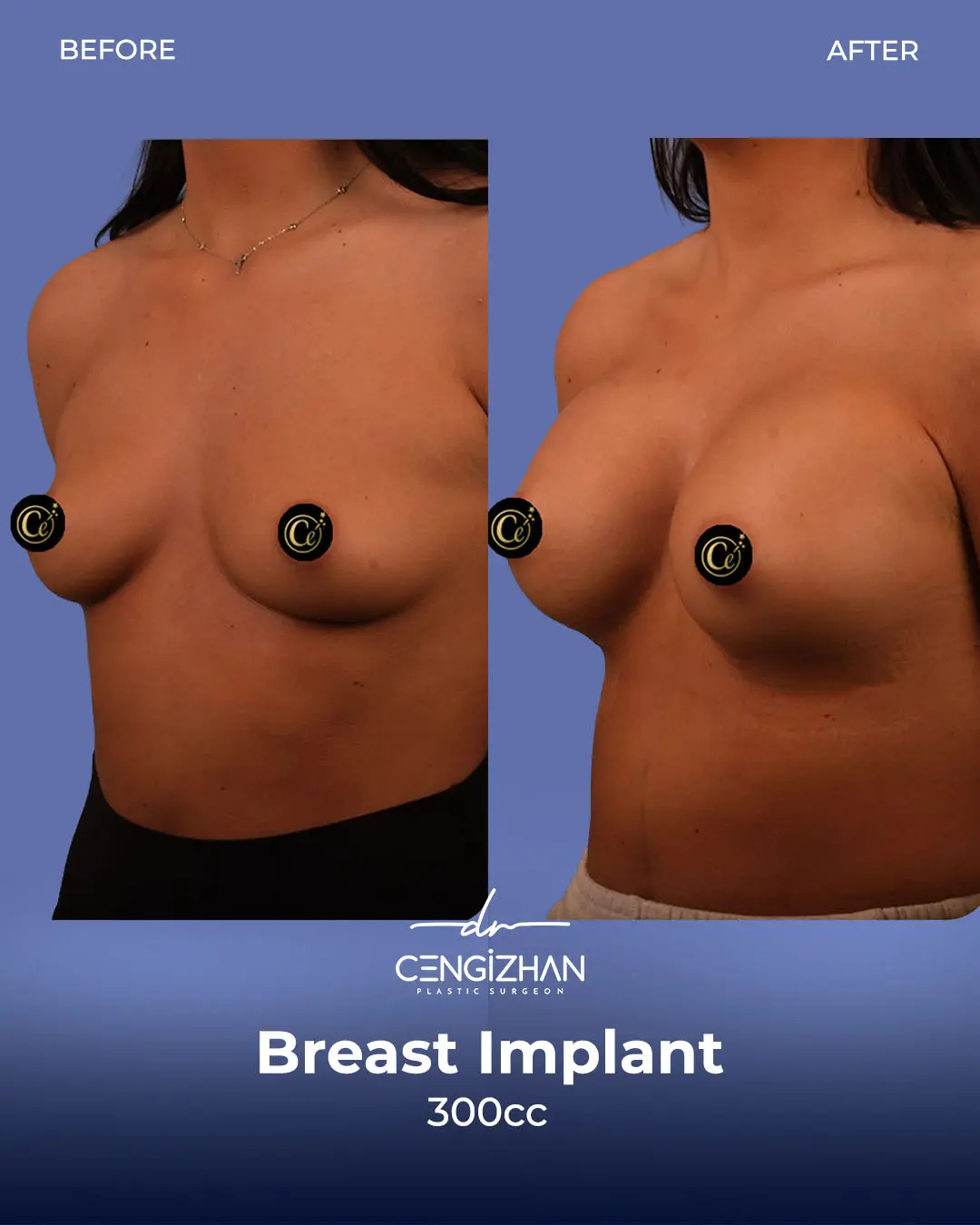Breast Implant Before and After by Dr. Cengizhan Ekizceli
