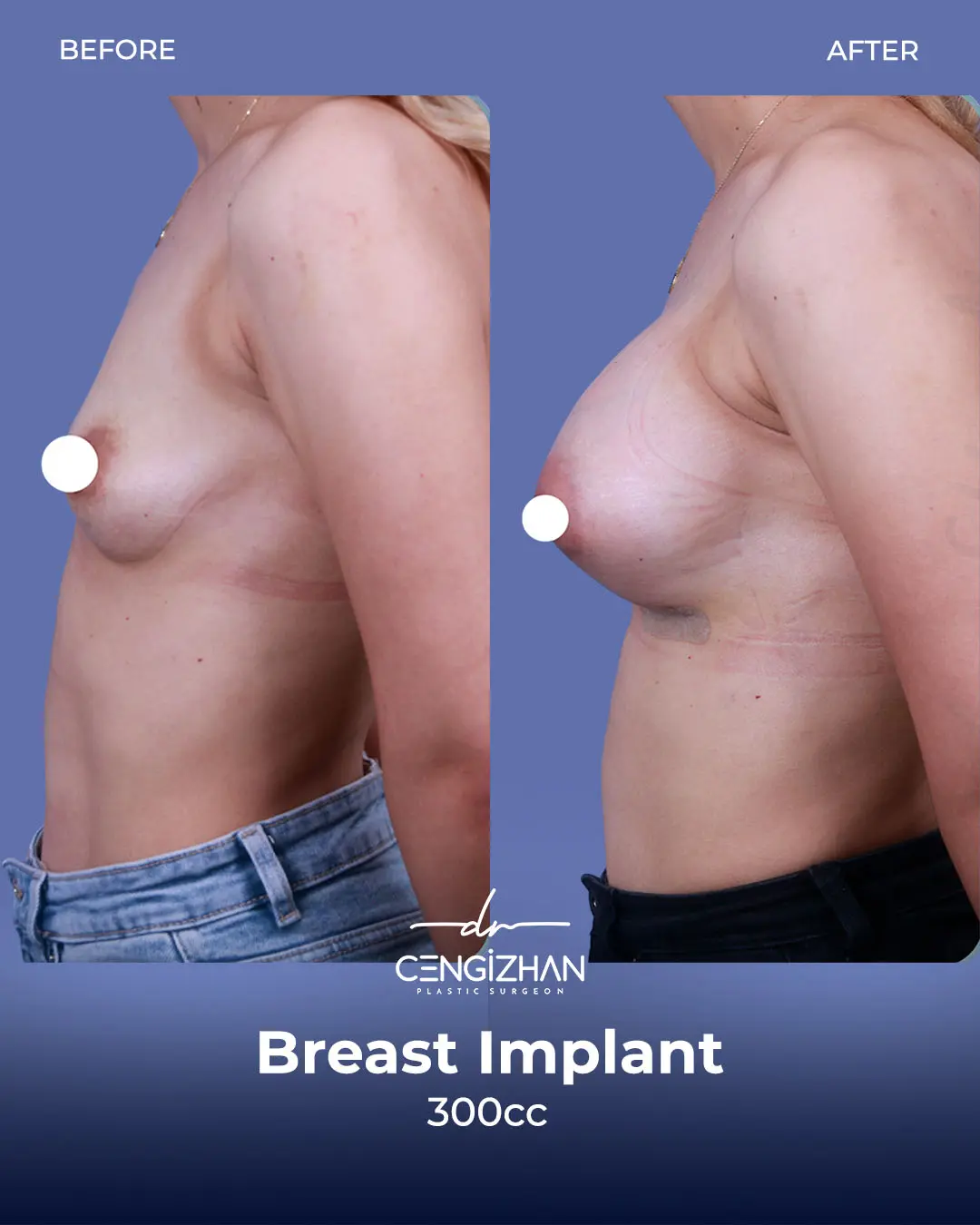 Breast Implant Before and After by Dr. Cengizhan Ekizceli