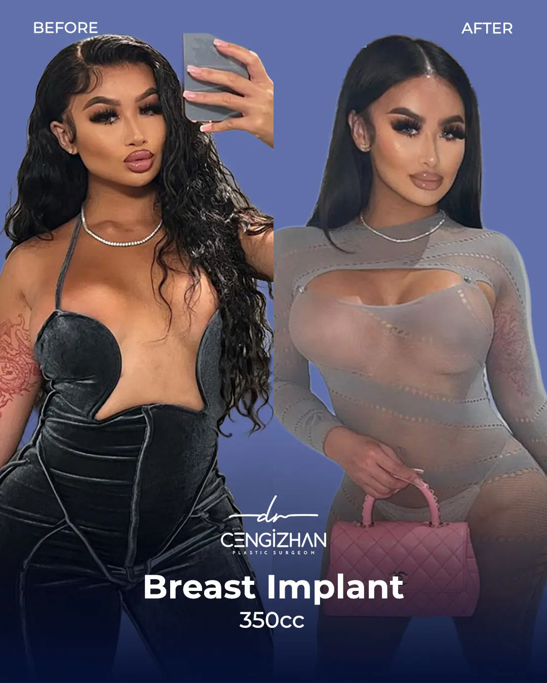Breast Implant Before and After by Dr. Cengizhan Ekizceli