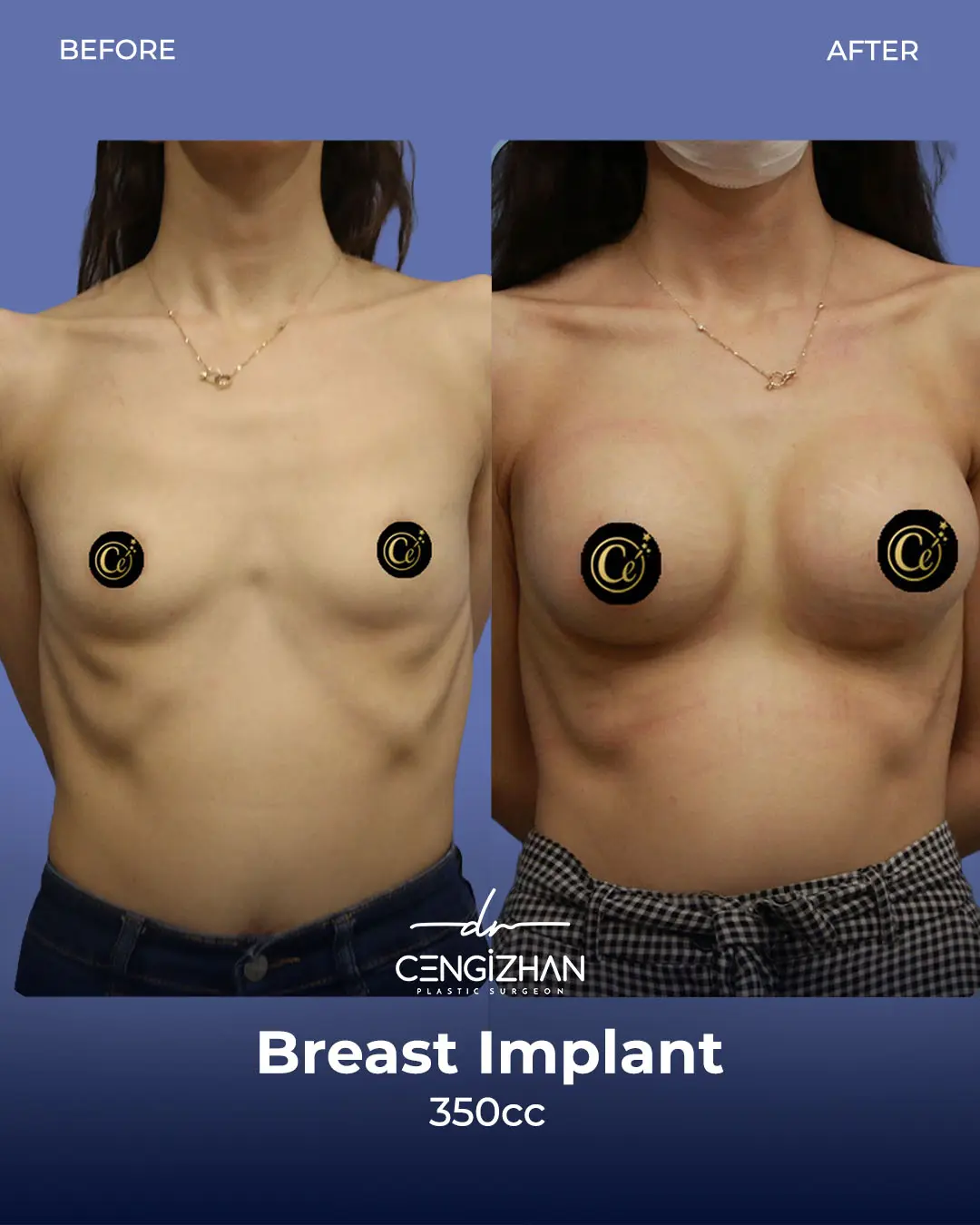 Breast Implant Before and After by Dr. Cengizhan Ekizceli