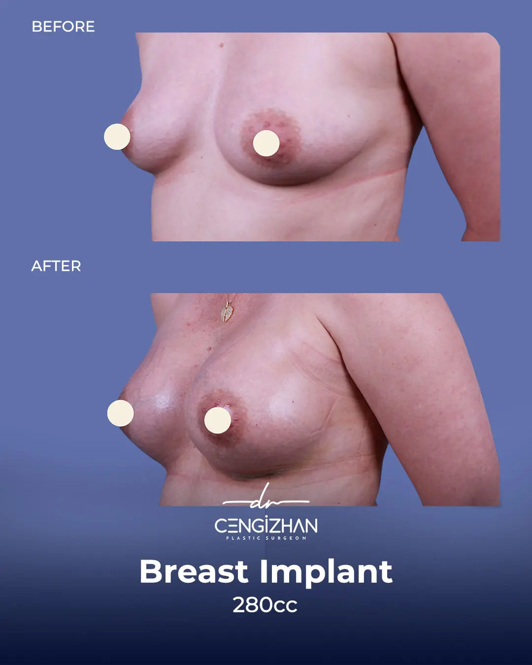 Breast Implant Before and After by Dr. Cengizhan Ekizceli