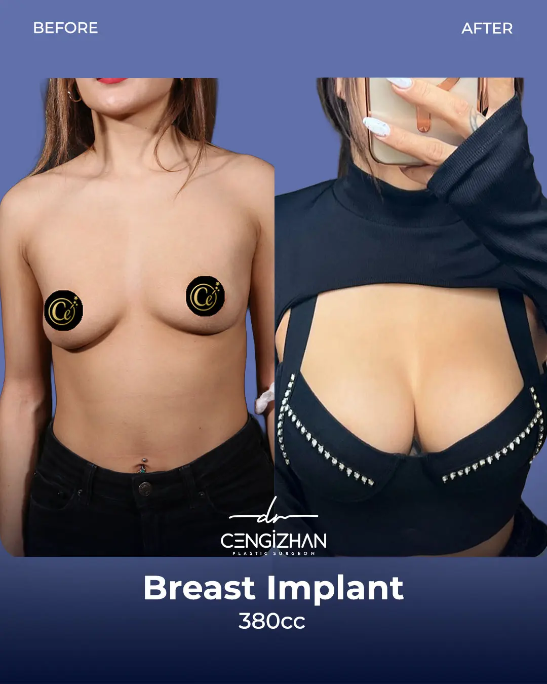 Breast Implant Before and After by Dr. Cengizhan Ekizceli
