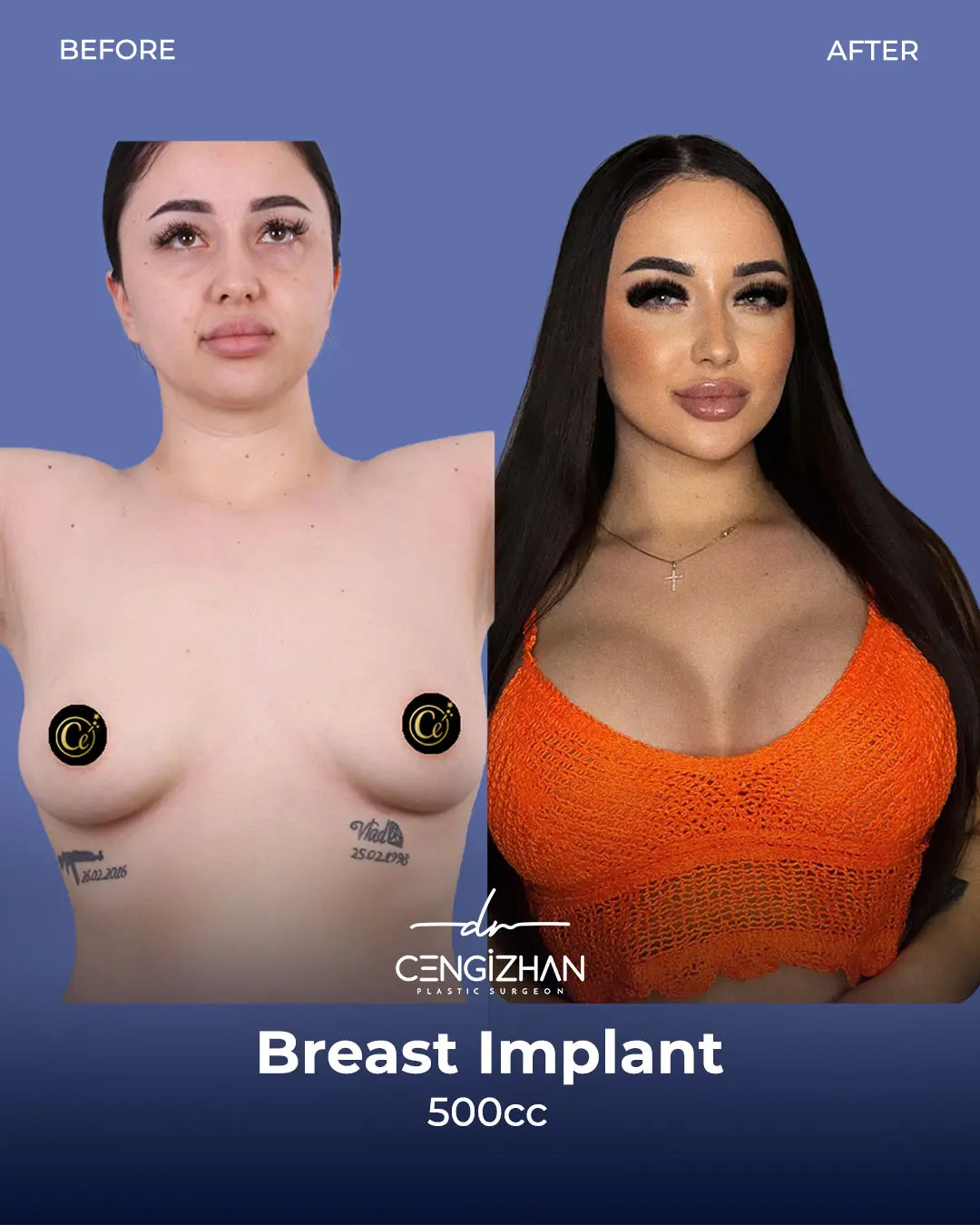 Breast Implant Before and After by Dr. Cengizhan Ekizceli