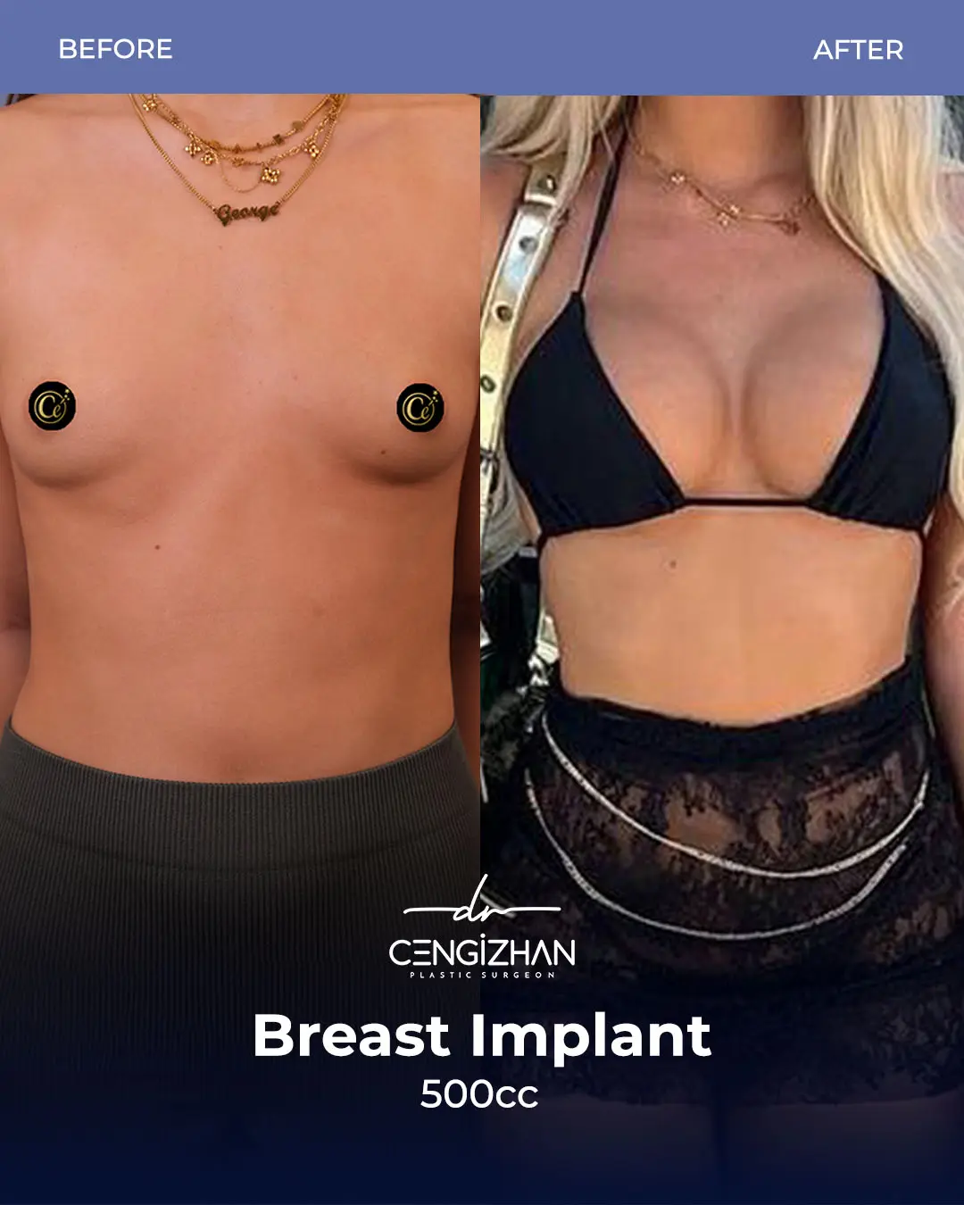 Breast Implant Before and After by Dr. Cengizhan Ekizceli