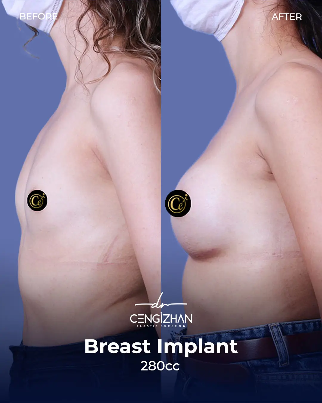 Breast Implant Before and After by Dr. Cengizhan Ekizceli