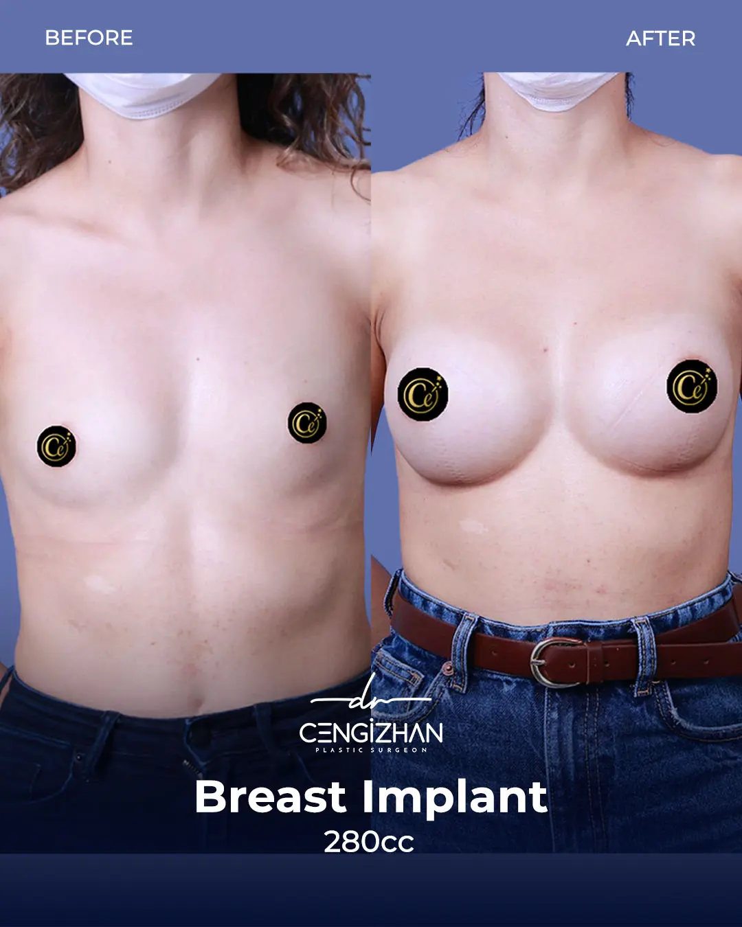 Breast Implant Before and After by Dr. Cengizhan Ekizceli