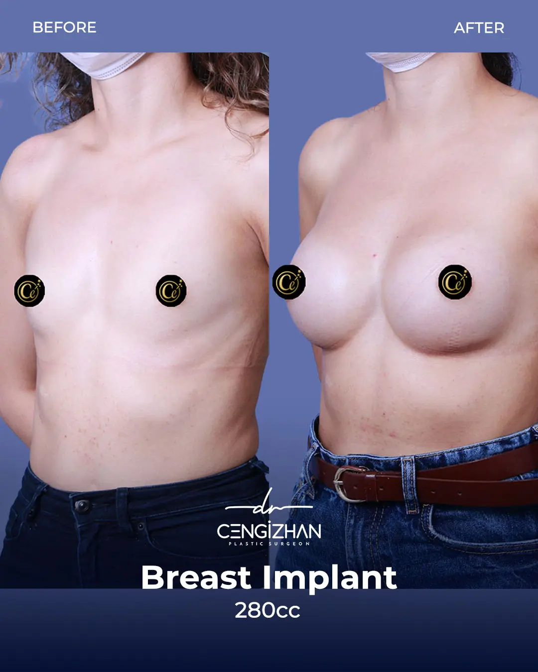 Breast Implant Before and After by Dr. Cengizhan Ekizceli