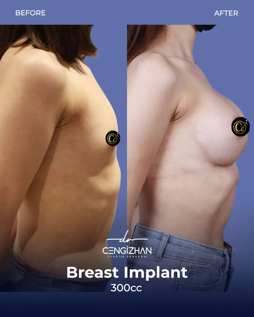 Breast Implant Before and After by Dr. Cengizhan Ekizceli