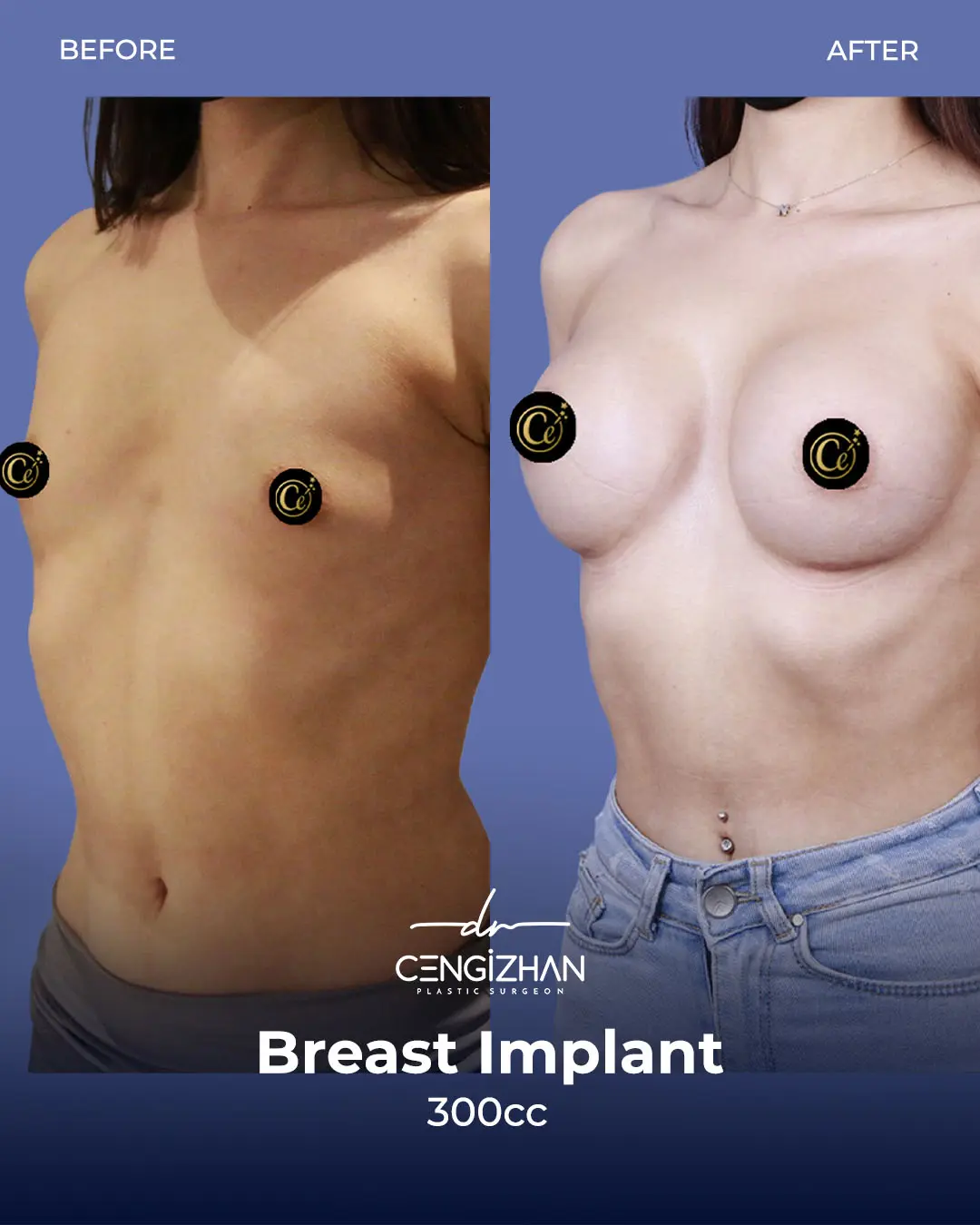 Breast Implant Before and After by Dr. Cengizhan Ekizceli