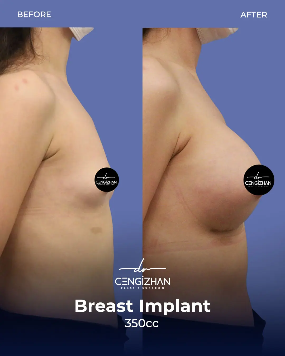 Breast Implant Before and After by Dr. Cengizhan Ekizceli