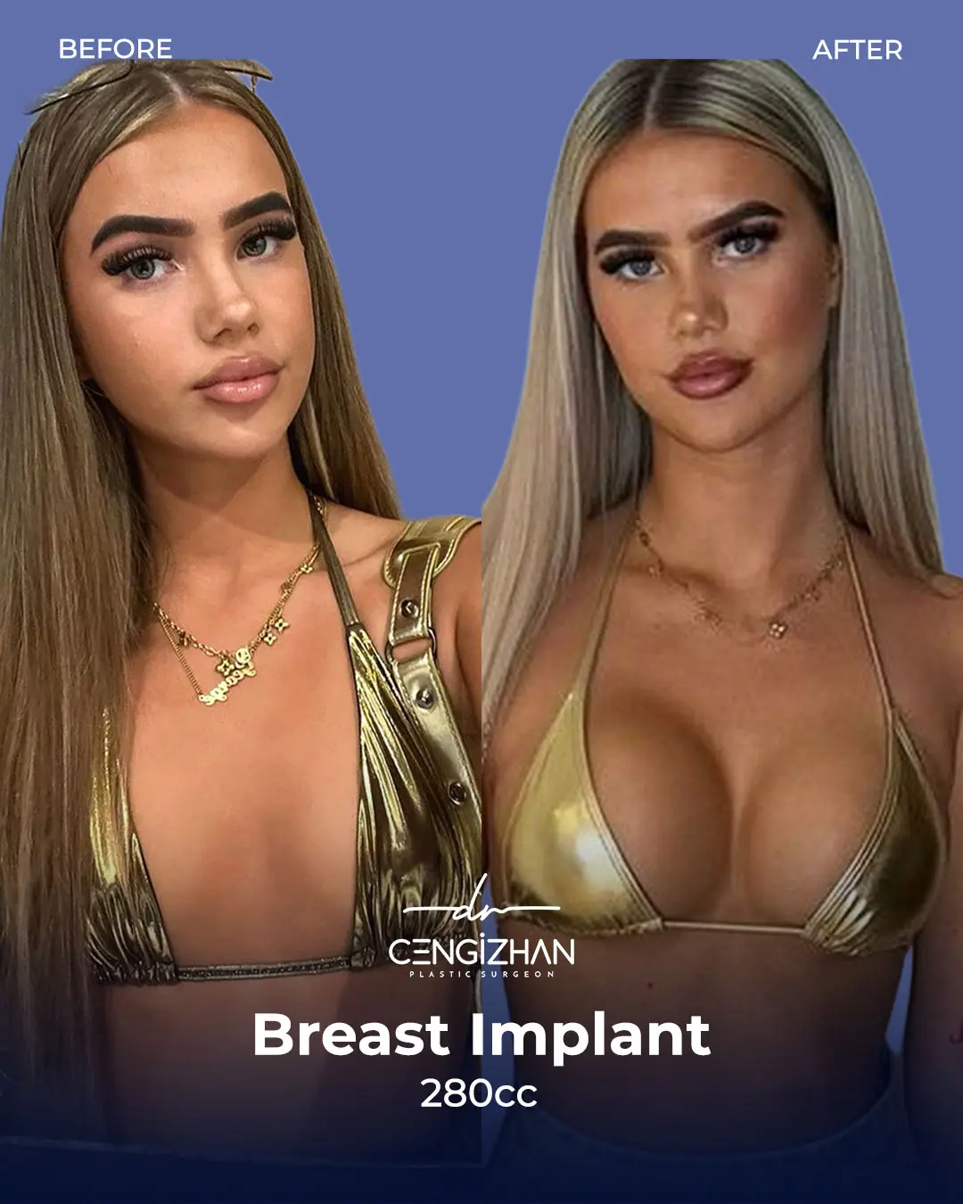Breast Implant Before and After by Dr. Cengizhan Ekizceli