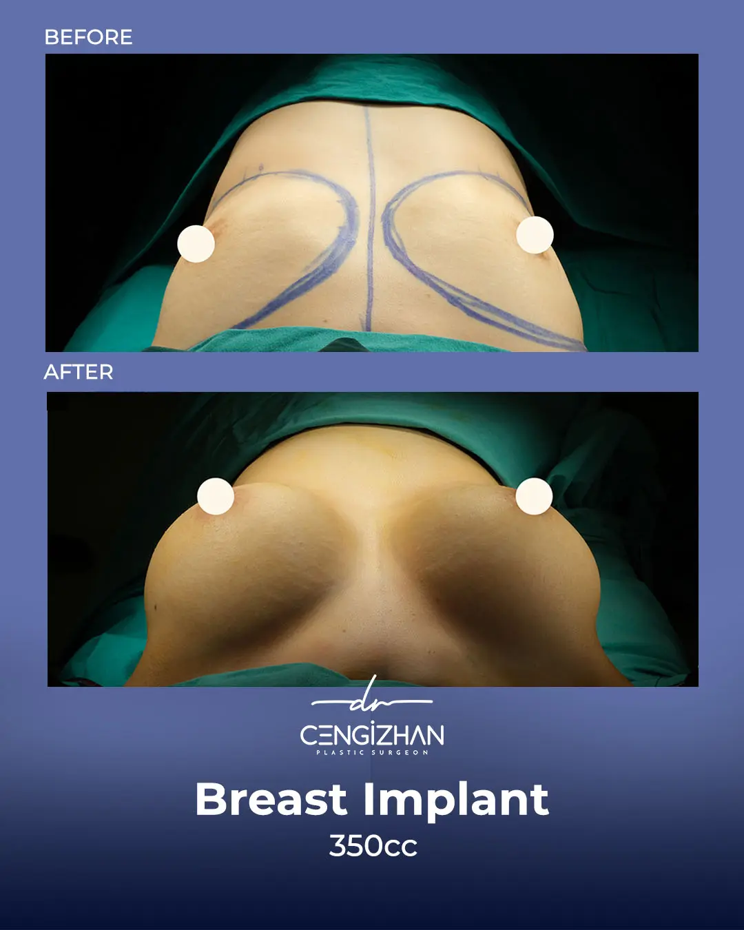 Breast Implant Before and After by Dr. Cengizhan Ekizceli