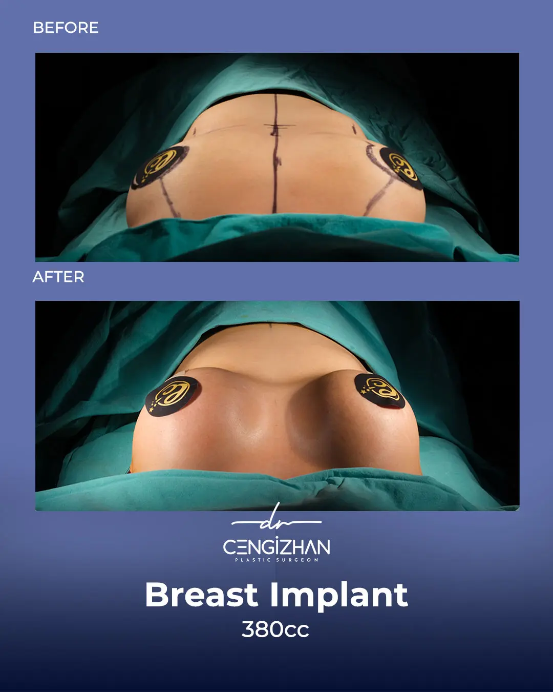 Breast Implant Before and After by Dr. Cengizhan Ekizceli