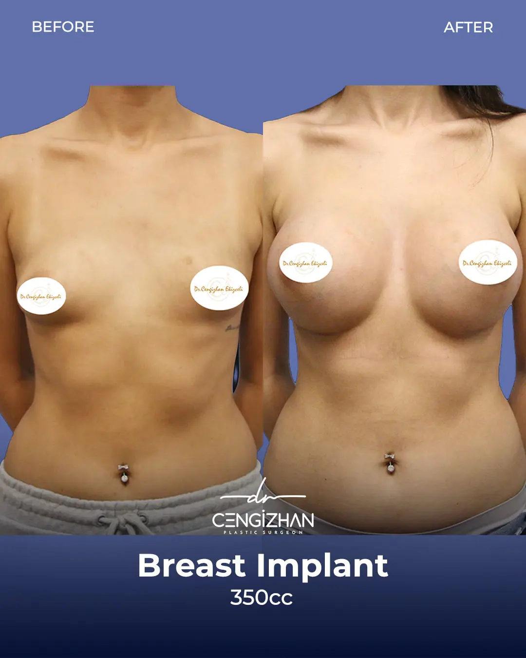 Breast Implant Before and After by Dr. Cengizhan Ekizceli