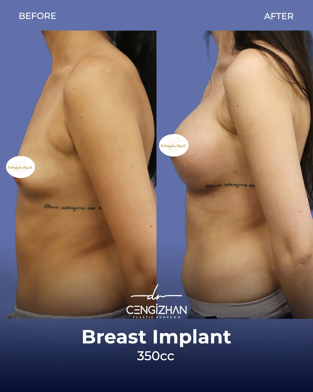 Breast Implant Before and After by Dr. Cengizhan Ekizceli
