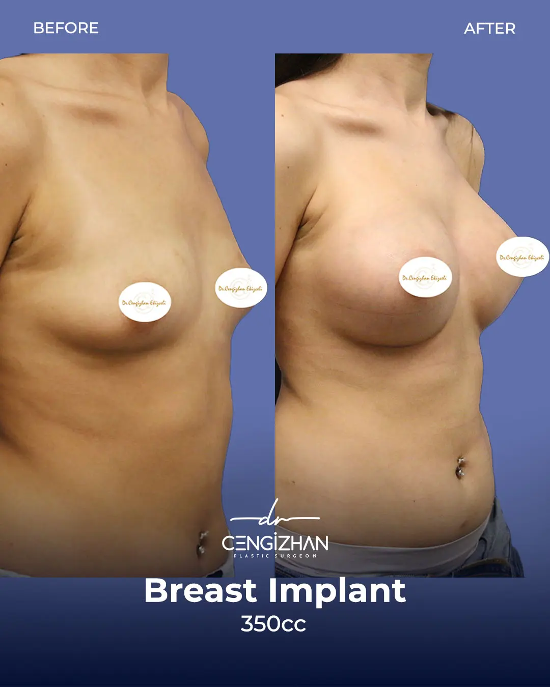 Breast Implant Before and After by Dr. Cengizhan Ekizceli