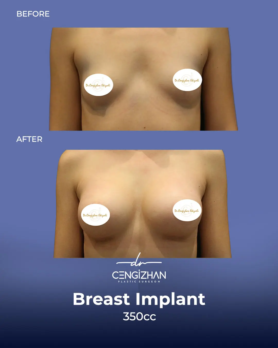 Breast Implant Before and After by Dr. Cengizhan Ekizceli