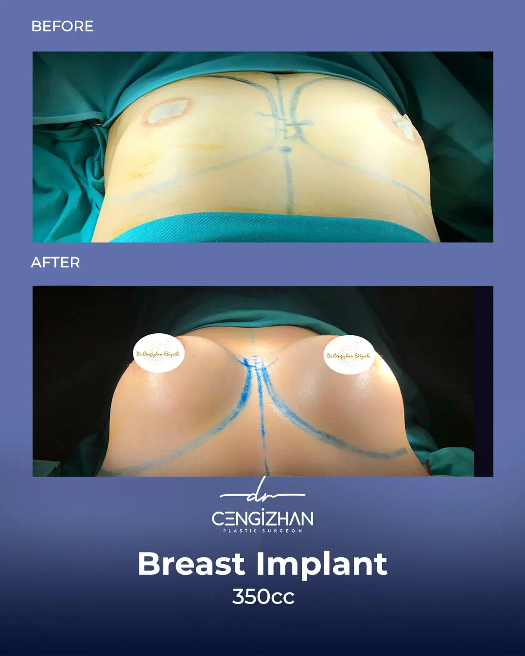Breast Implant Before and After by Dr. Cengizhan Ekizceli