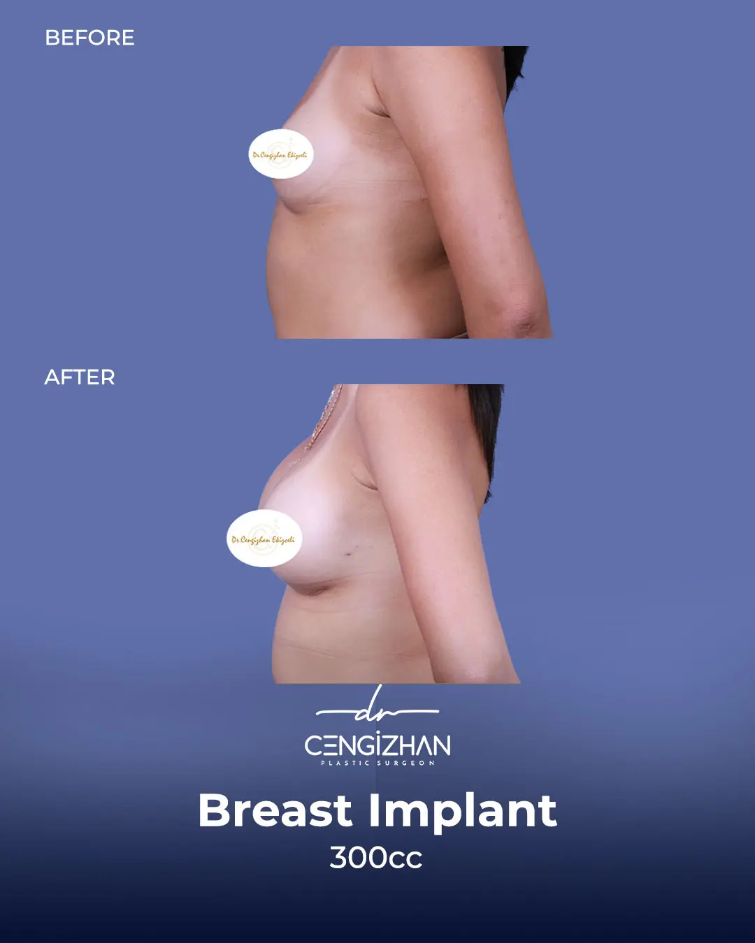 Breast Implant Before and After by Dr. Cengizhan Ekizceli