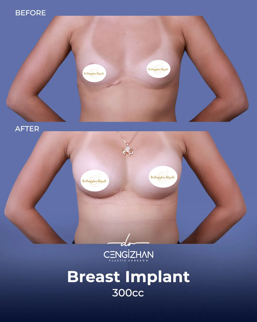 Breast Implant Before and After by Dr. Cengizhan Ekizceli