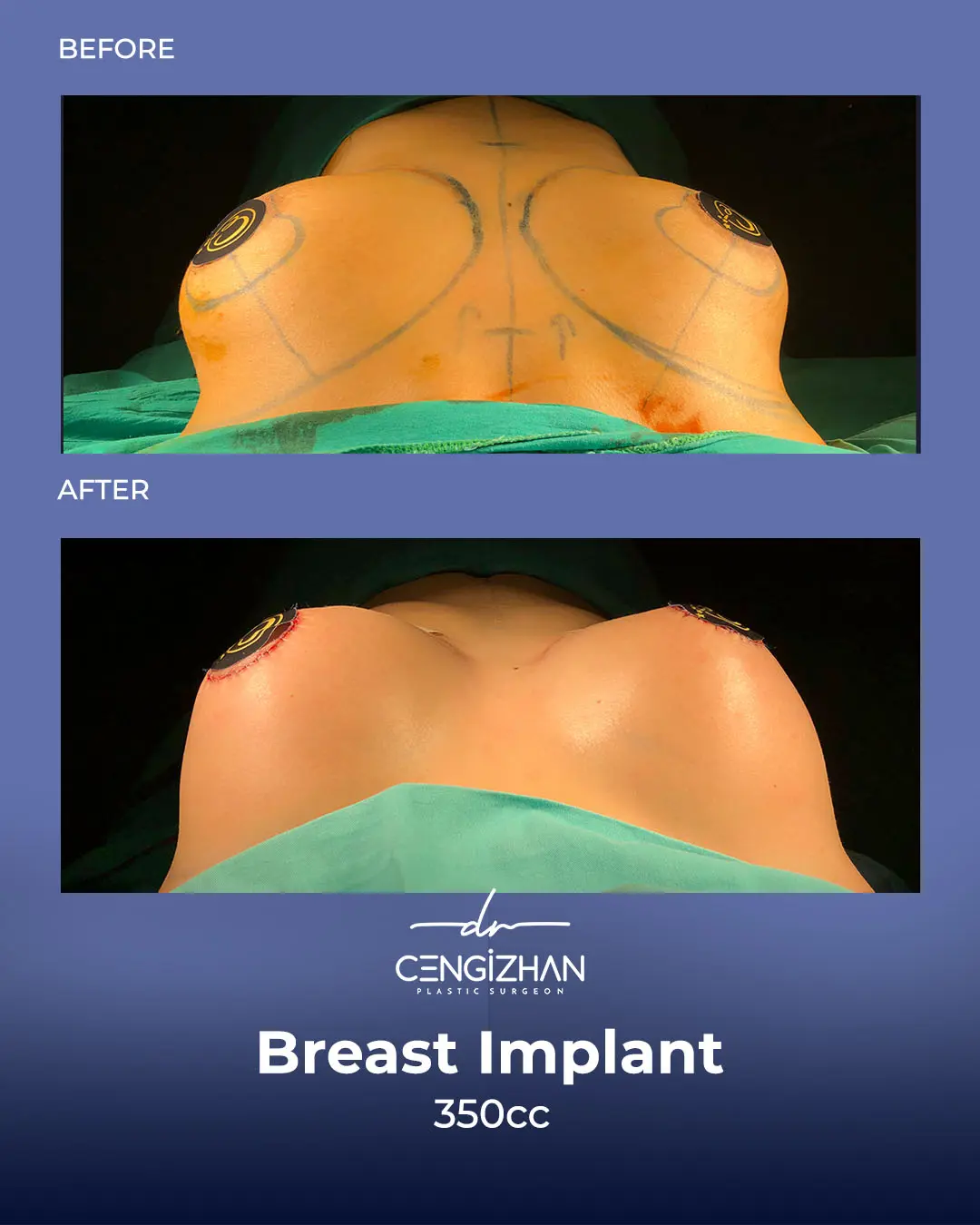 Breast Implant Before and After by Dr. Cengizhan Ekizceli