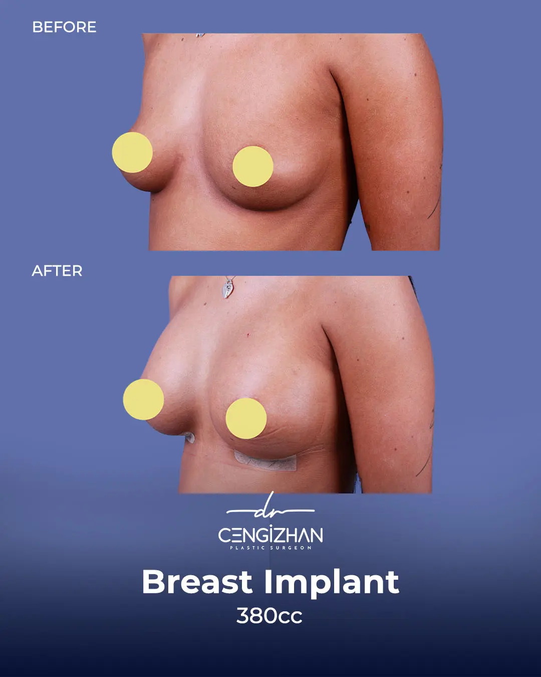 Breast Implant Before and After by Dr. Cengizhan Ekizceli