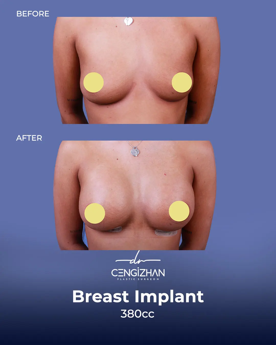 Breast Implant Before and After by Dr. Cengizhan Ekizceli