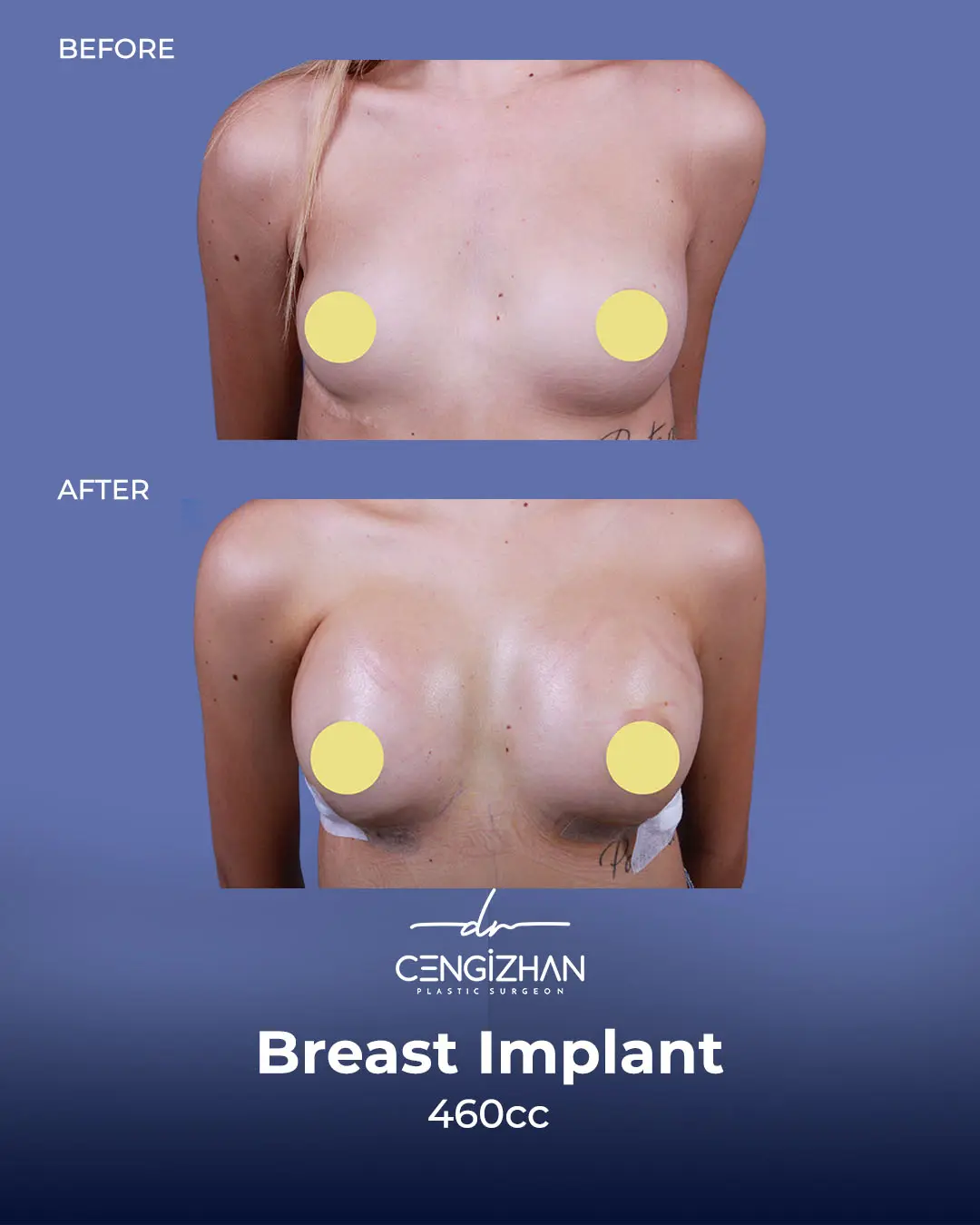 Breast Implant Before and After by Dr. Cengizhan Ekizceli