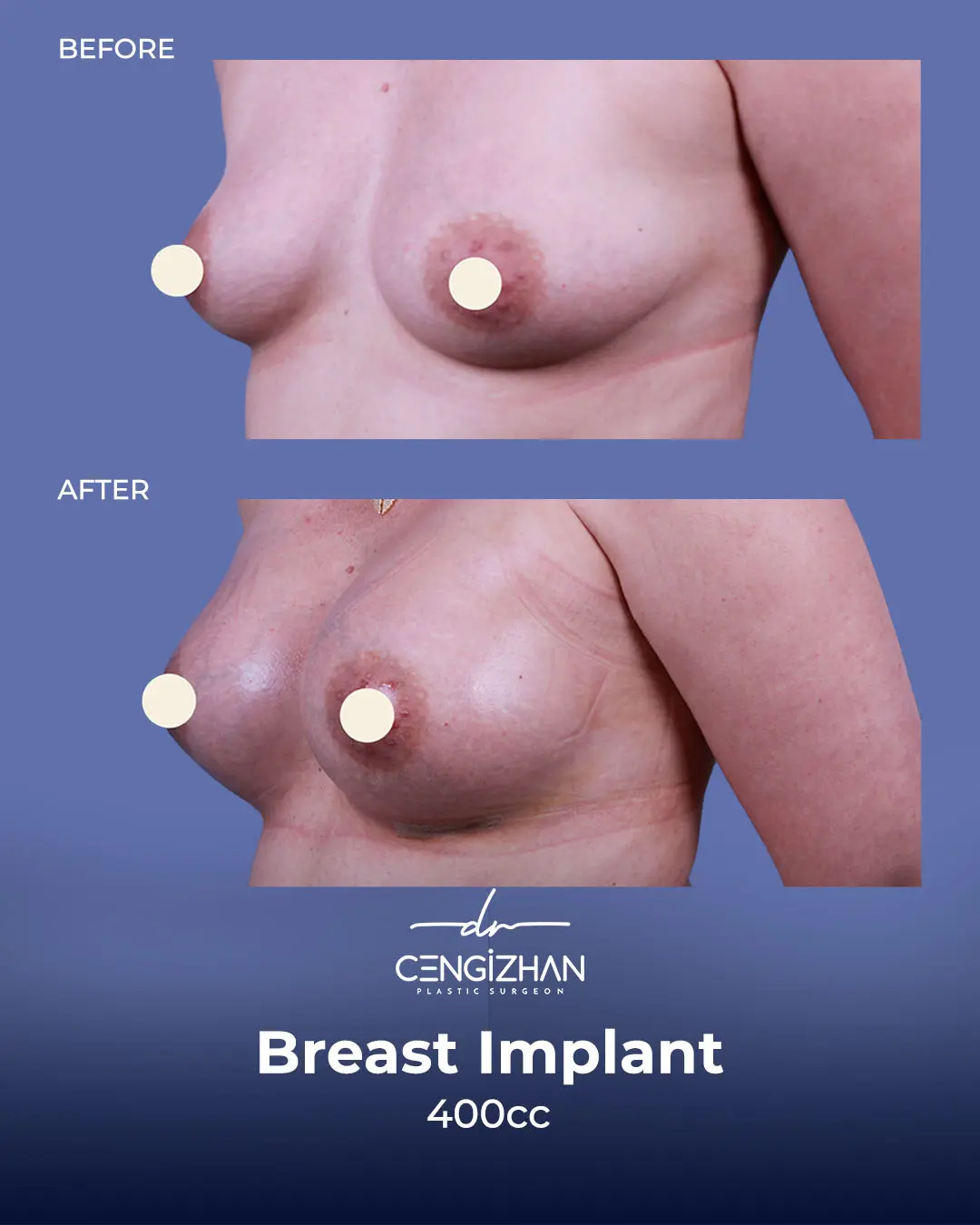 Breast Implant Before and After by Dr. Cengizhan Ekizceli