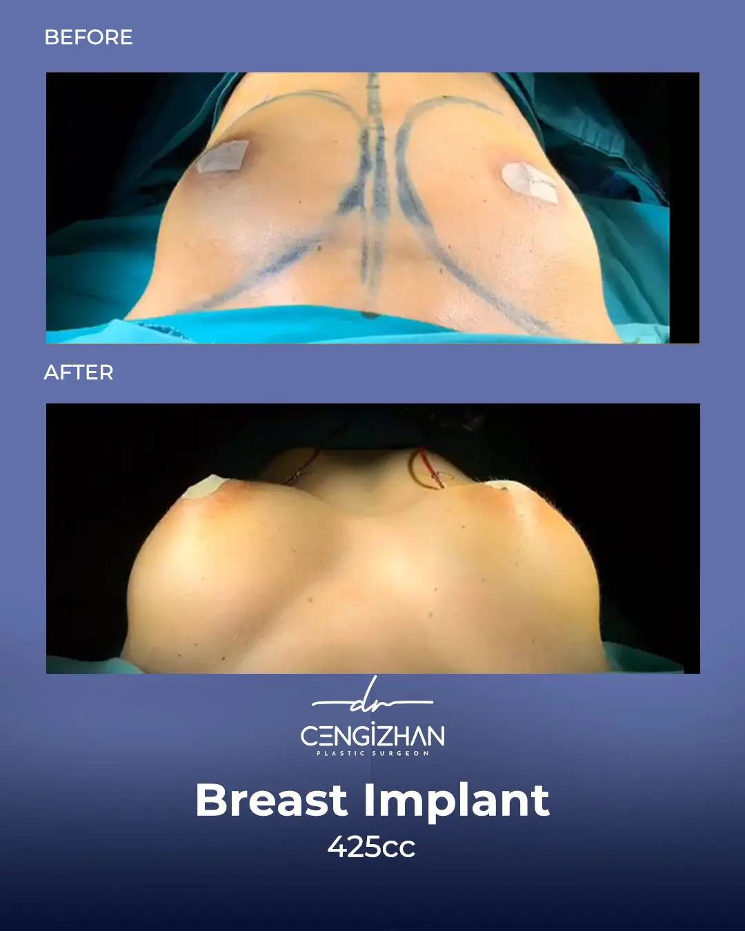 Breast Implant Before and After by Dr. Cengizhan Ekizceli