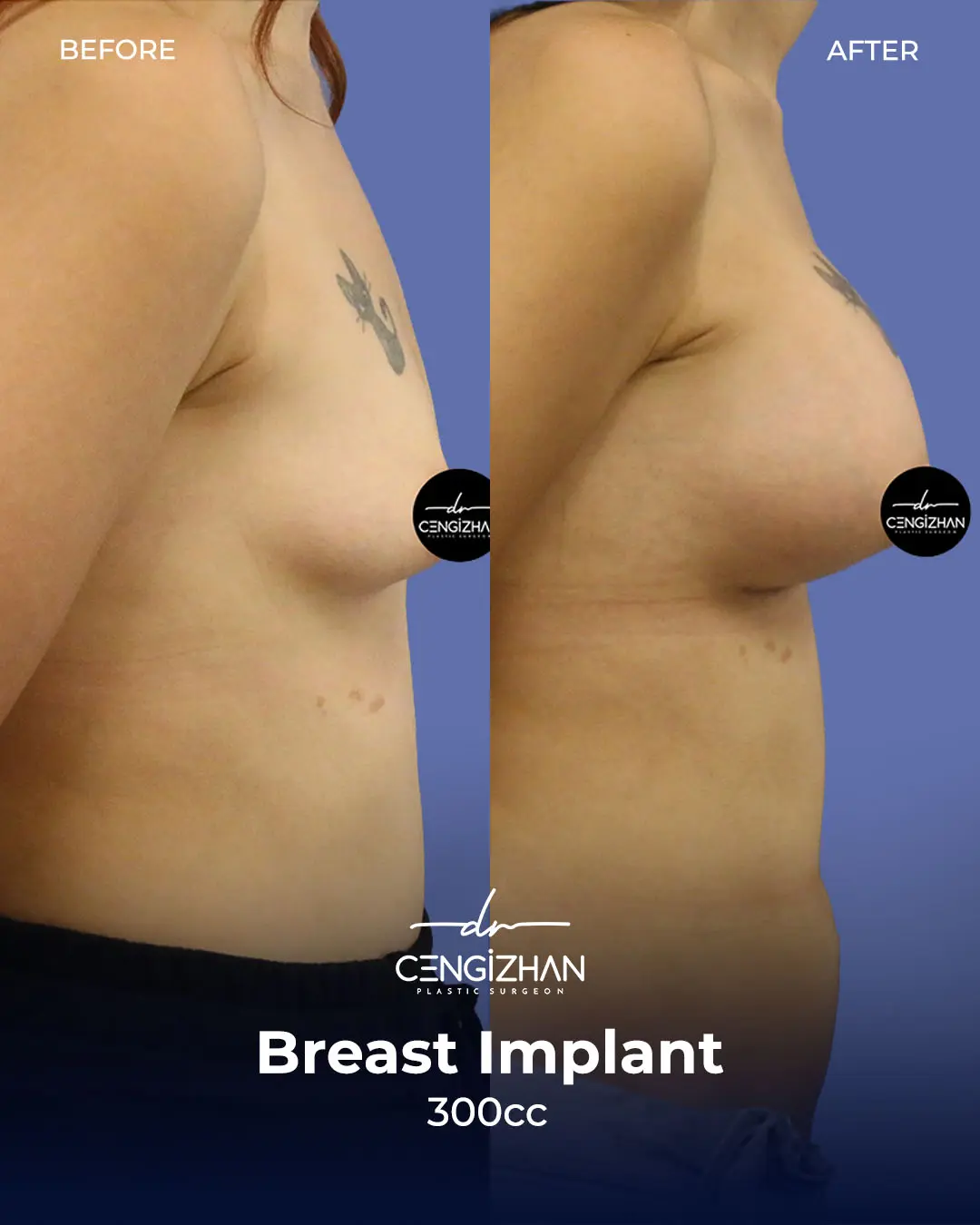 Breast Implant Before and After by Dr. Cengizhan Ekizceli