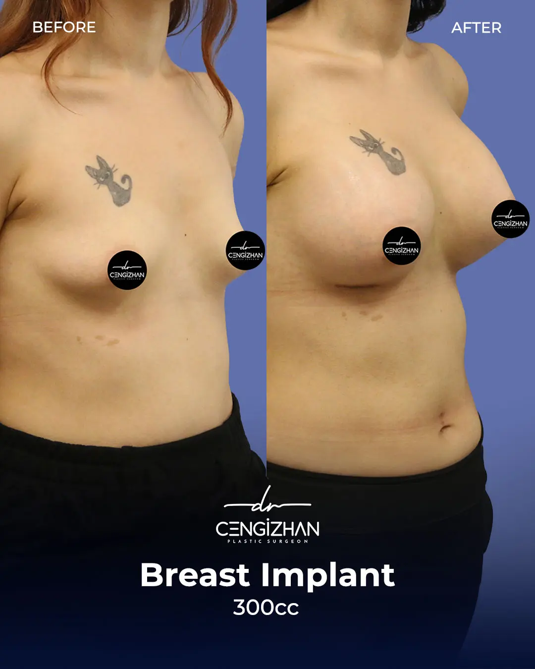 Breast Implant Before and After by Dr. Cengizhan Ekizceli