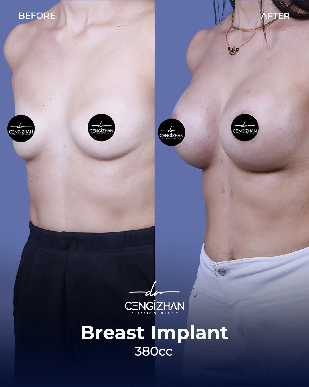 Breast Implant Before and After by Dr. Cengizhan Ekizceli