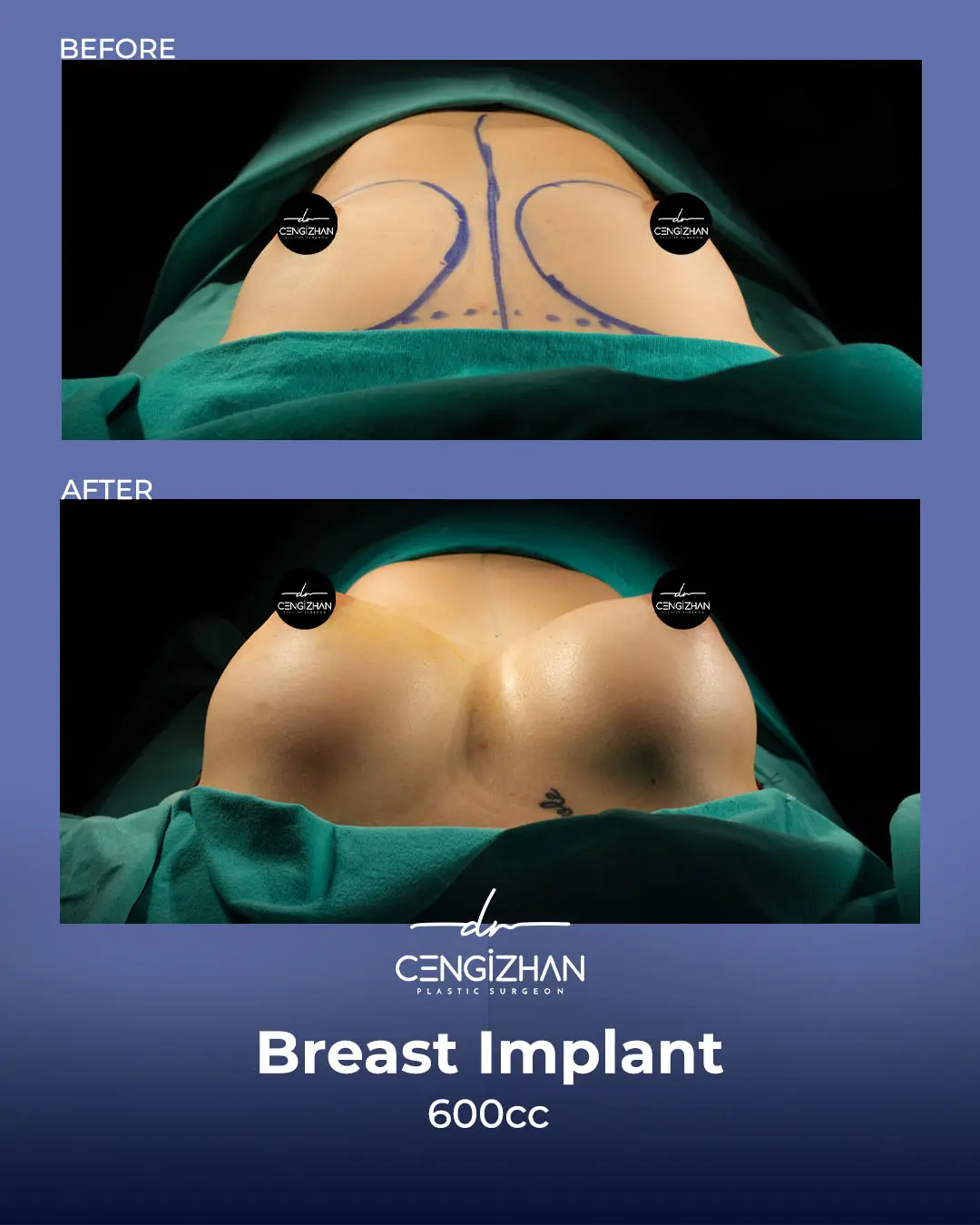 Breast Implant Before and After by Dr. Cengizhan Ekizceli