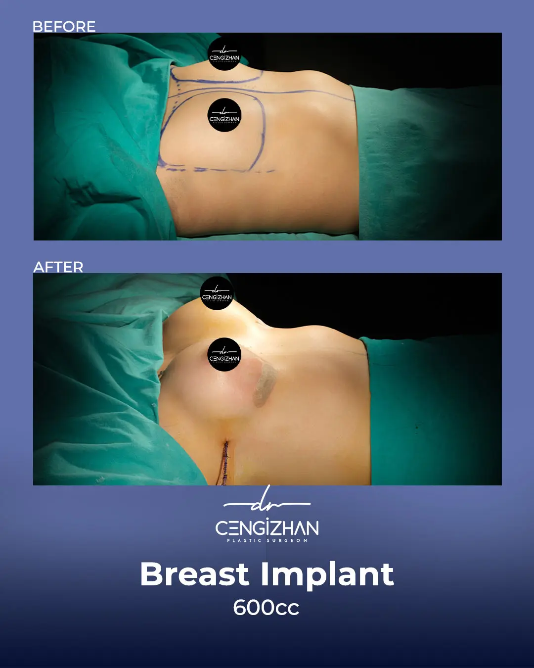 Breast Implant Before and After by Dr. Cengizhan Ekizceli