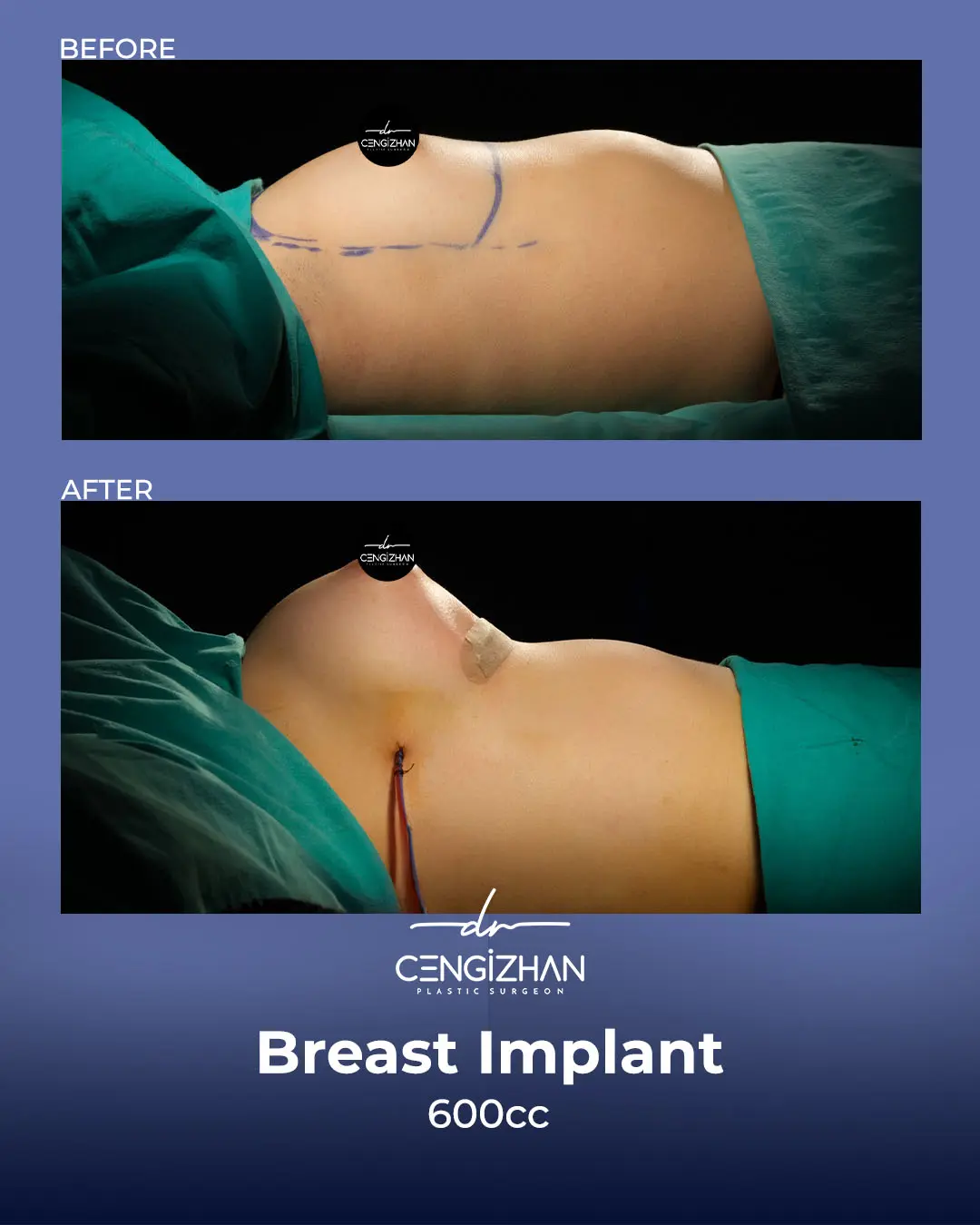 Breast Implant Before and After by Dr. Cengizhan Ekizceli