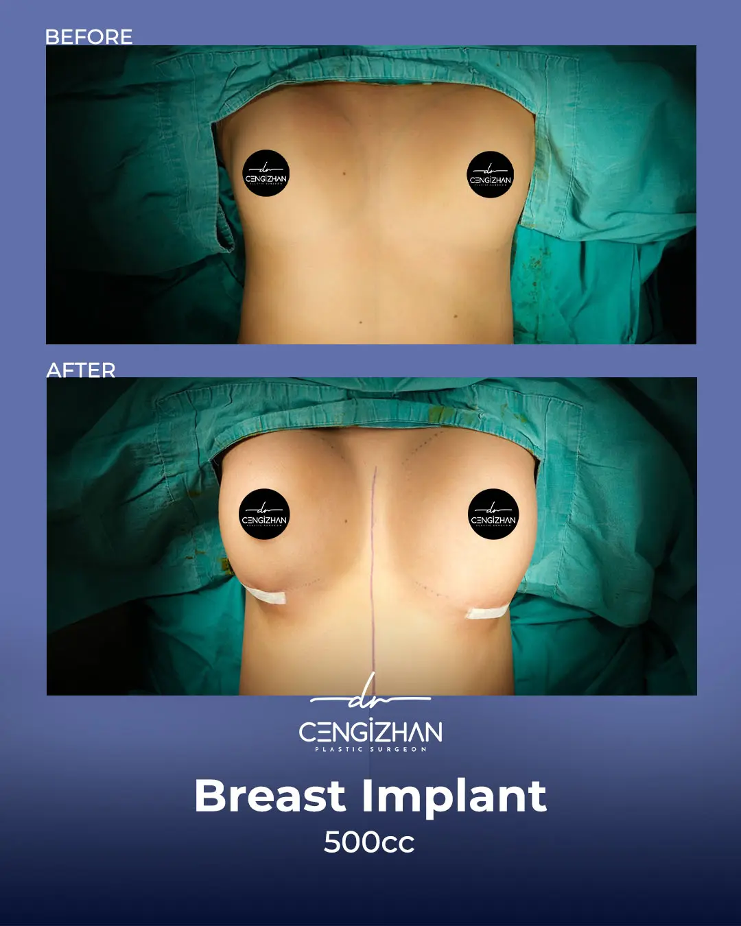 Breast Implant Before and After by Dr. Cengizhan Ekizceli