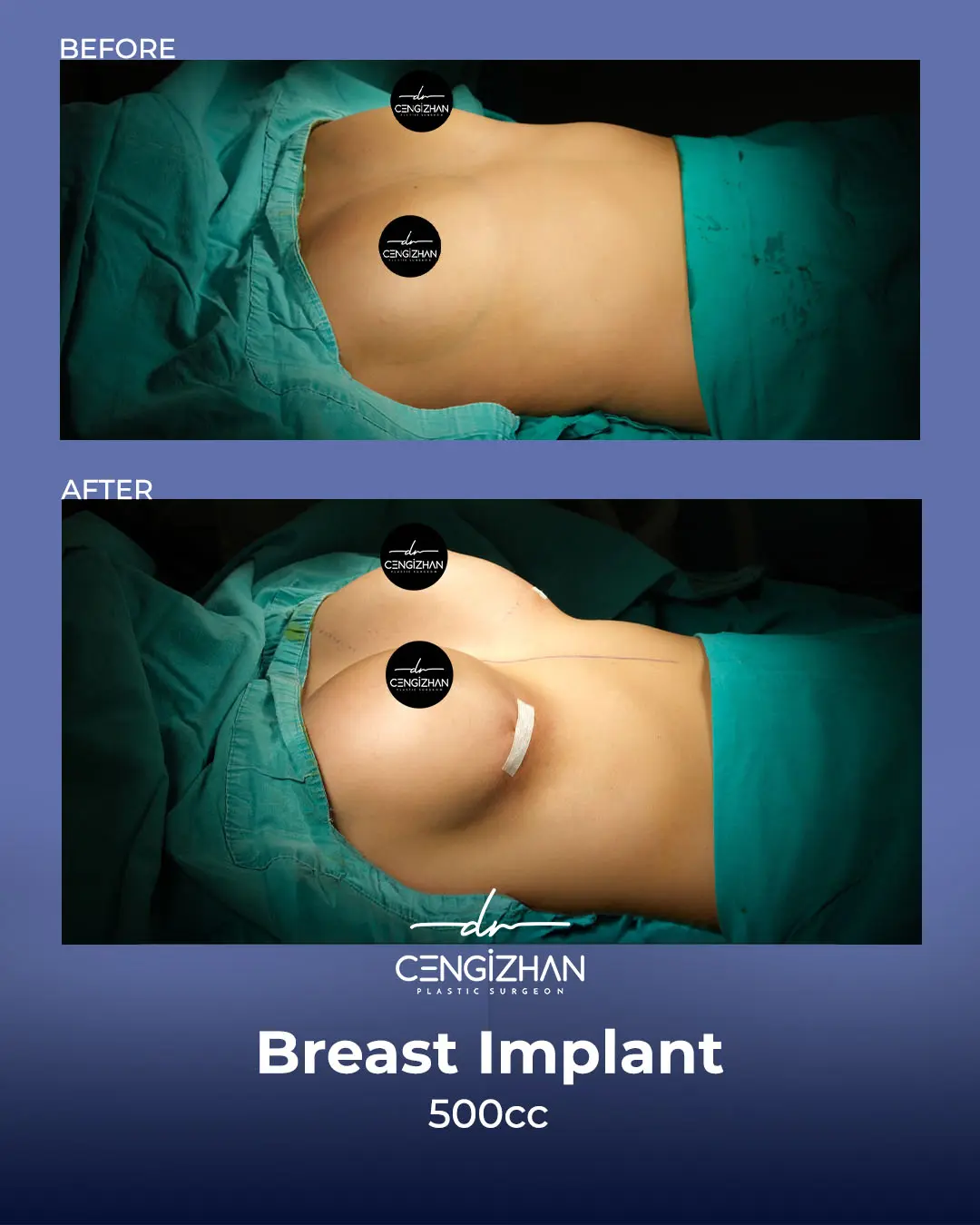 Breast Implant Before and After by Dr. Cengizhan Ekizceli