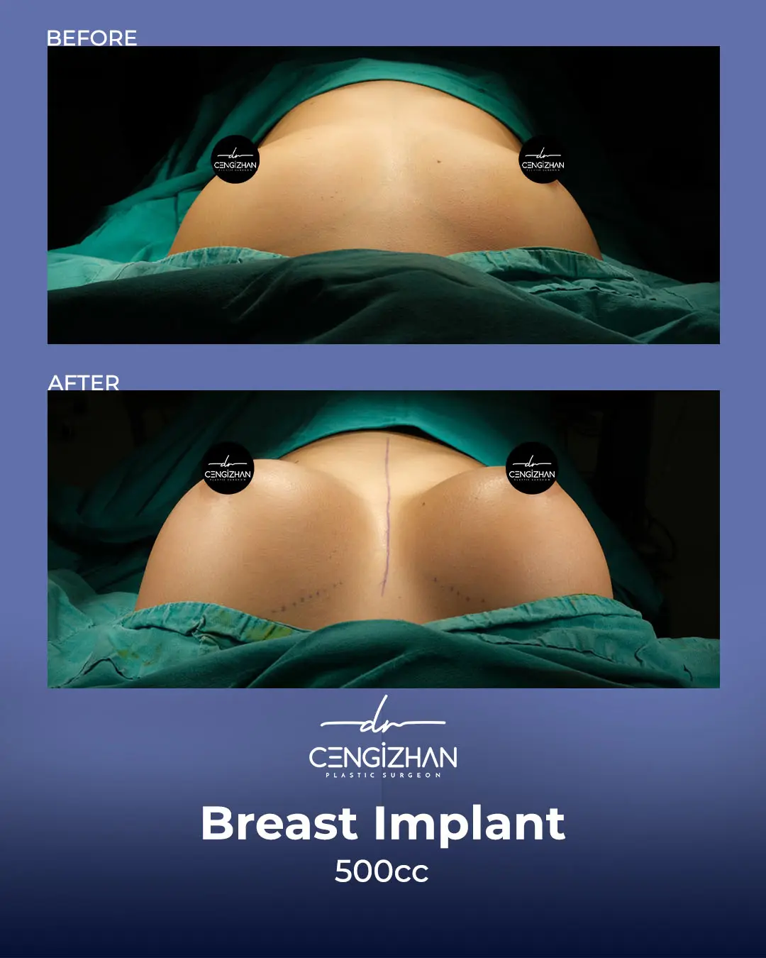 Breast Implant Before and After by Dr. Cengizhan Ekizceli