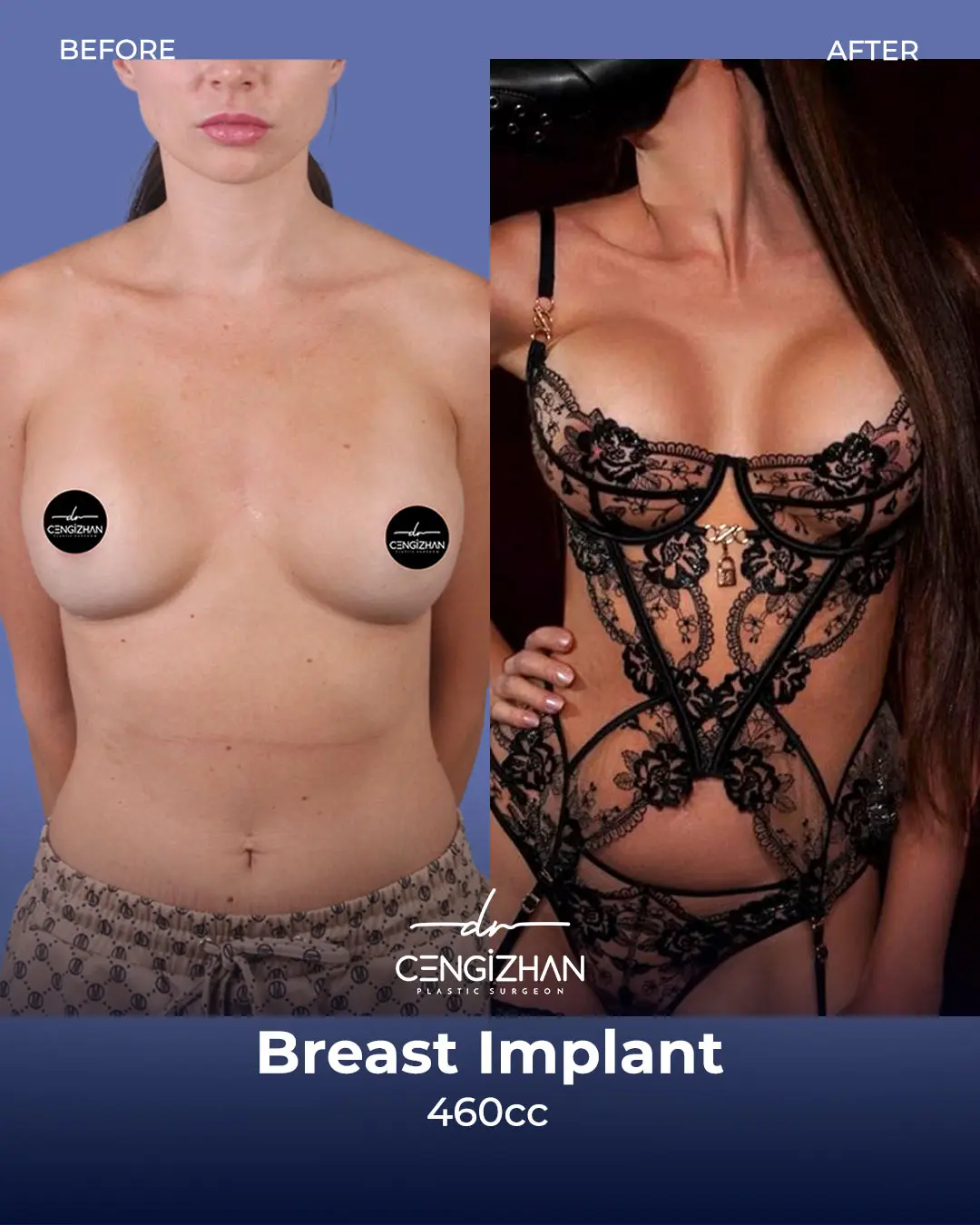 Breast Implant Before and After by Dr. Cengizhan Ekizceli