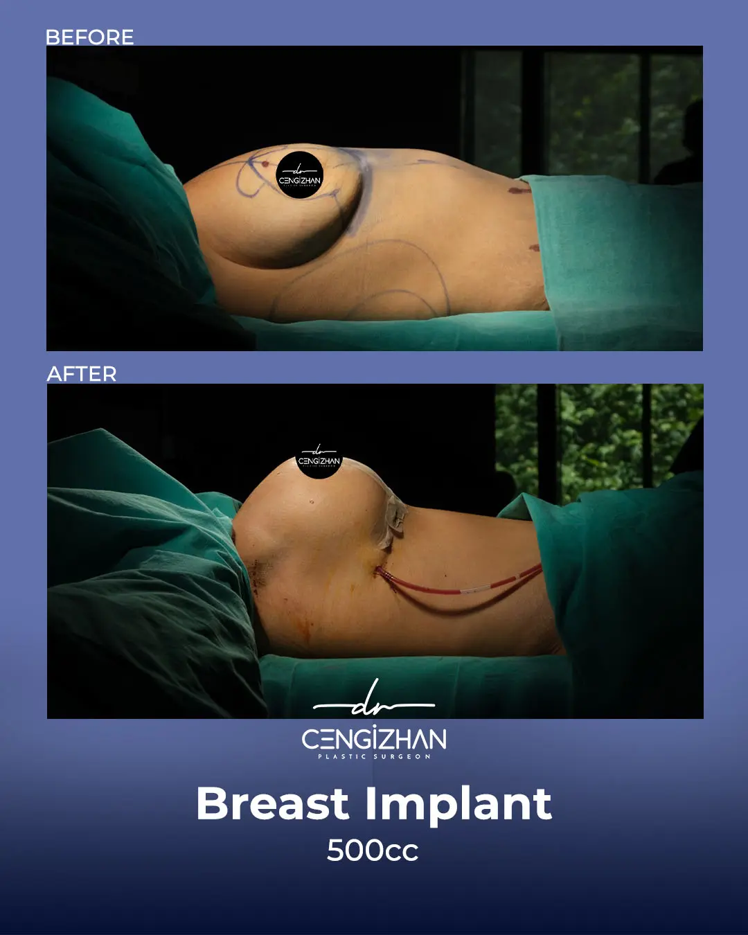 Breast Implant Before and After by Dr. Cengizhan Ekizceli