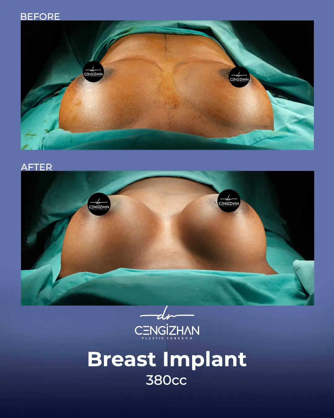 Breast Implant Before and After by Dr. Cengizhan Ekizceli