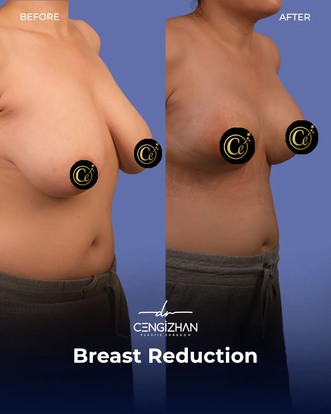 Breast Reduction Before and after photo by Dr. Cengizhan Ekizceli