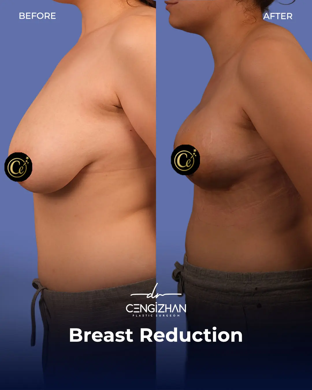 Breast Reduction Before and after photo by Dr. Cengizhan Ekizceli