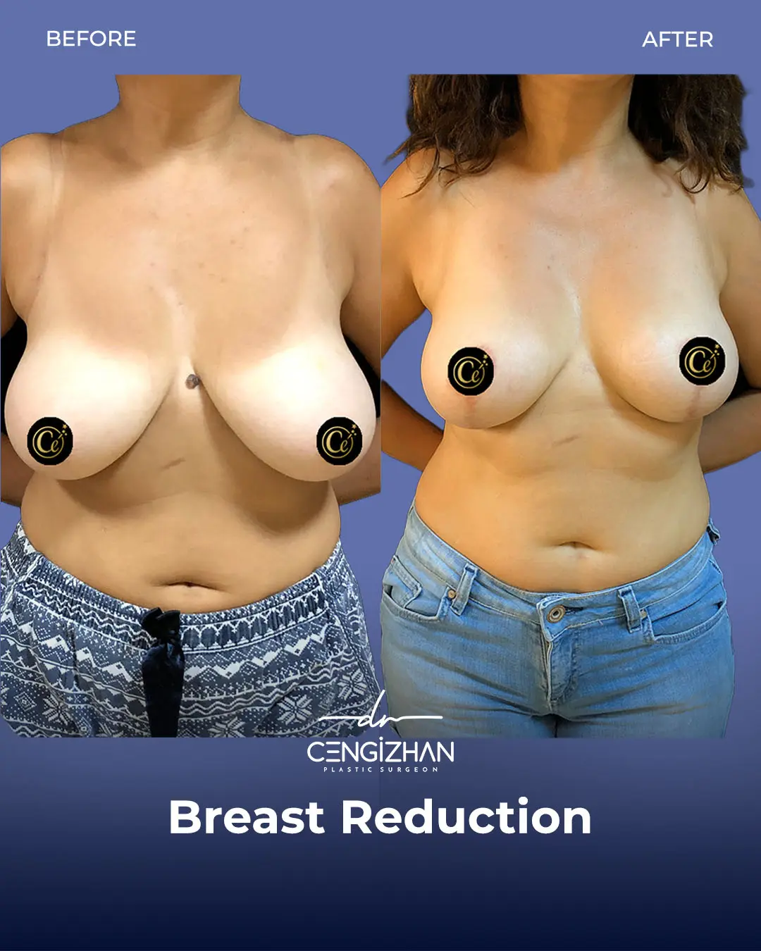 Breast Reduction Before and after photo by Dr. Cengizhan Ekizceli