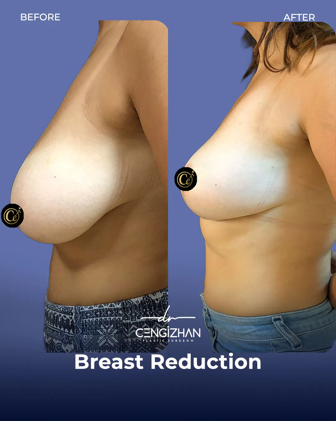 Breast Reduction Before and after photo by Dr. Cengizhan Ekizceli